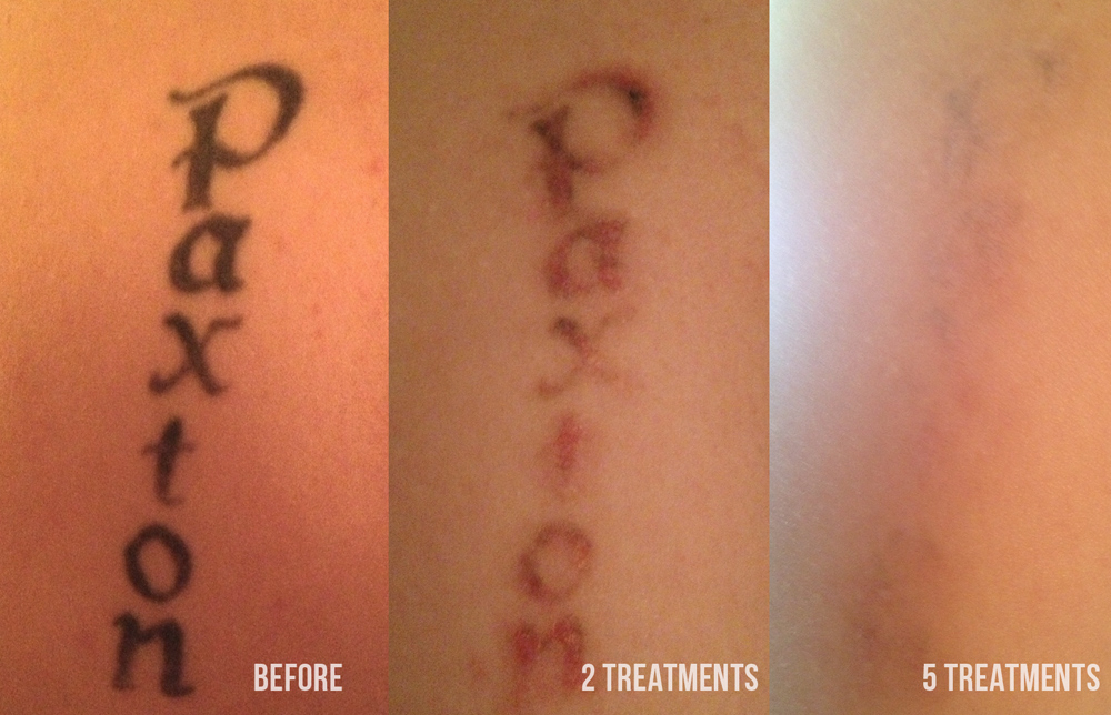 that have received laser tattoo removal. As you can see, even after ...